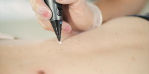 Cryotherapie